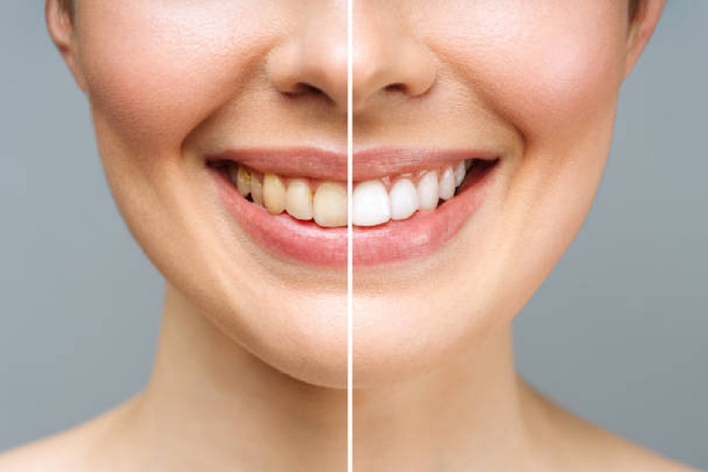 Cara Alami Memutihkan Gigi Berikut Tips Agar Senyuman Lebih Cerah dan Sehat