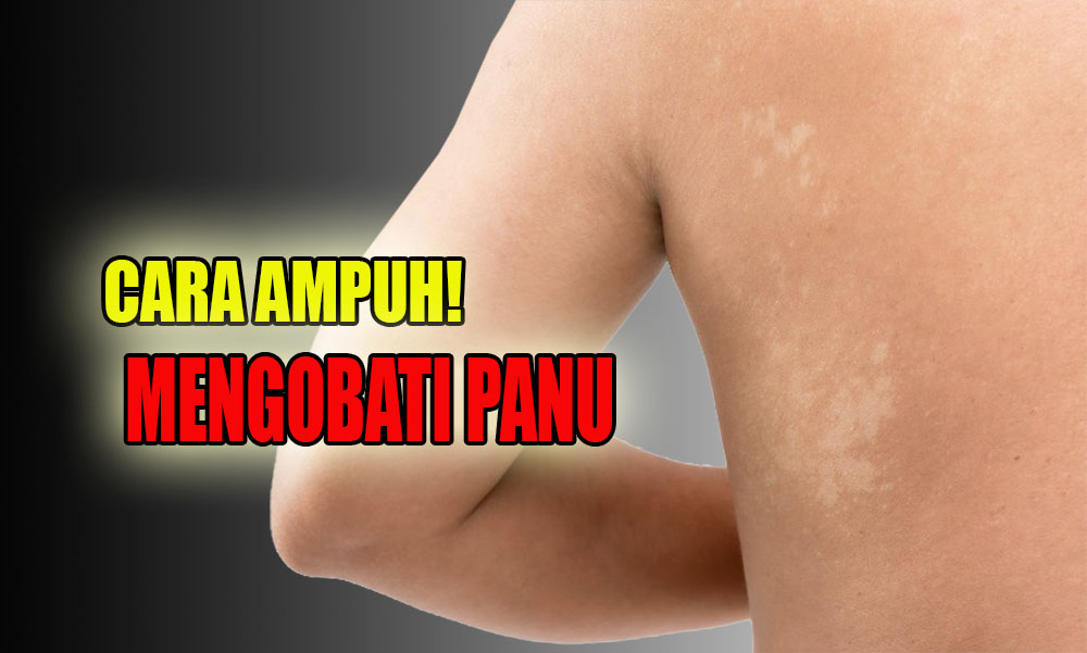 1 Hari Langsung Sembuh, Ini 5 Rekomendasi Obat Herbal Yang Ampuh Mengobati Panu