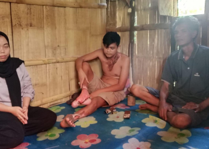 Kondisi Korban Luka Bakar Akibat Sengatan Listrik Makin Parah, PLN dan Kapolres Turun Tangan!