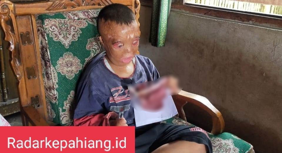 Diki Mengalami Luka Bakar di Wajah dan Kehilangan Alis Mata Sejak Usianya 9 Bulan