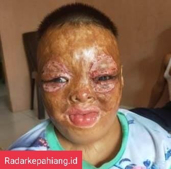 Usai Menjalani Operasi di Palembang, Alhamdulillah Diki Sudah Bisa Memejamkan Mata